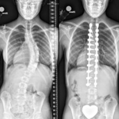 X-ray of Jessie's spine before and after surgery, showing it curved then straight.