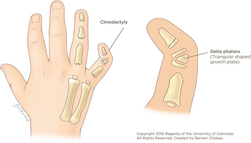 An illustration of a hand with the pinky finger bent inward toward the ring finger. Next to it is a close-up illustration of the bent joint showing a triangular shaped growth plate called the delta phalanx that is causing the finger to bend.