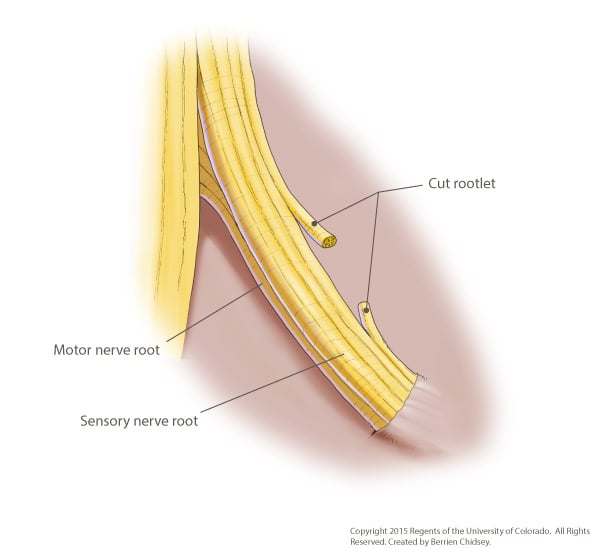 A graphic rendering of the spinal cord with a sensory nerve root cut and identified as a cut rootlet.